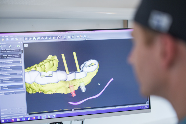 Implantatplanung (Straumann), navigierte Implantologie, CoDiagnostix, Bohrschablone in der Praxis Dr. Müller & Dr. Bethge Hamburg Landungsbrücken